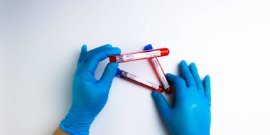 flasks with blood tests for coronavirus positive and negative, mpox