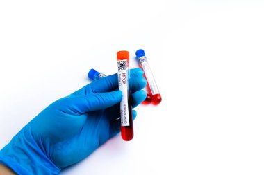flasks with blood tests for coronavirus positive and negative, mpox