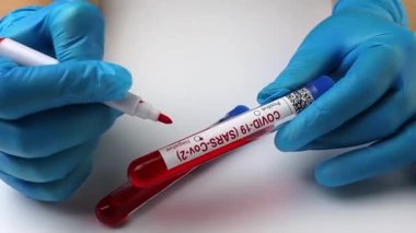 flasks with blood tests for coronavirus positive and negative, mpox