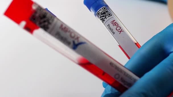 Flasks Blood Tests Coronavirus Positive Negative Mpox — стоковое видео
