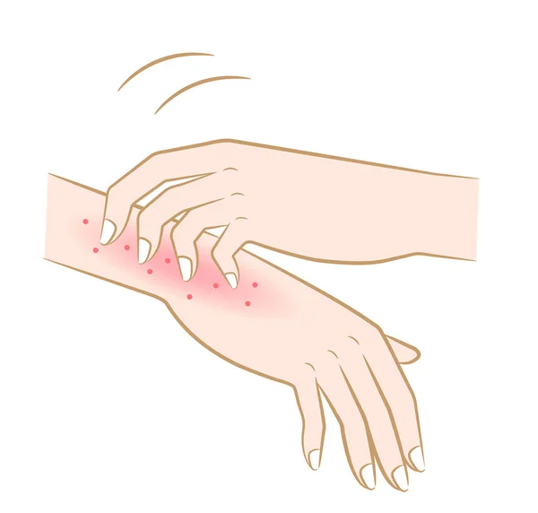 Das Kratzen Der Juckenden Hände Rötung Hautausschlag Trockene Haut Ekzeme — Stockvektor