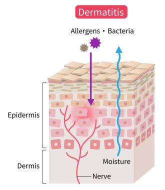 atopik dermatit (egzama) deri tabakası çizimi. Nemlendirme bariyerini bozarak dış uyarıcıları aşmamızı sağlıyor. Sağlıklı cilt bakımı kavramı