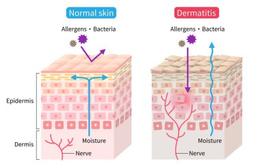 atopik dermatit (egzama) ve normal deri hücre çizimi. Sağlıklı cilt bakımı kavramı
