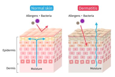 atopik dermatit (egzama) kuru ve normal deri hücre çizimi. Önce ve sonra. Sağlıklı ve güzel cilt bakımı