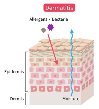 atopik dermatit kuru deri hücre katmanı. Egzama, nem bariyerini bozar ve dış uyarıcıları aşar. Sağlıklı ve güzel cilt bakımı 