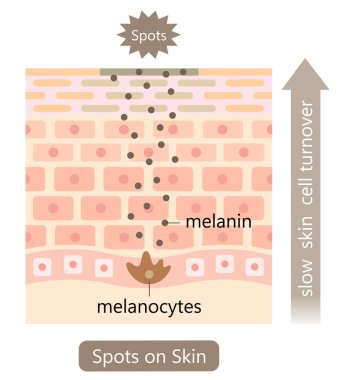 skin cell turnover and dark spots illustration. melanin and melanocytes in human skin layer. Beauty and skin care concept