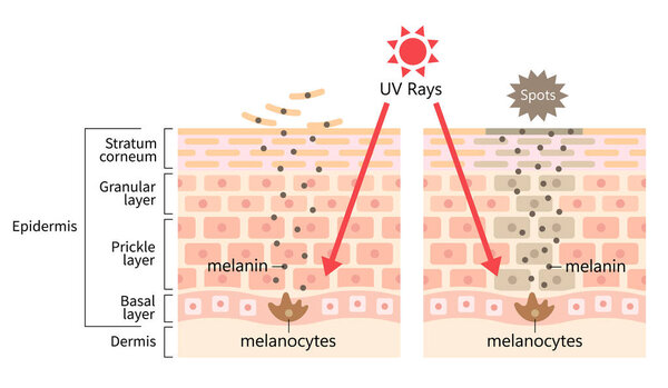УФ-излучение солнца вызывает темное пятно меланином. Человеческий слой кожи и клеточная иллюстрация. Концепция красоты и здоровья 