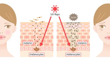 suns UV radiation induces dark spot by melanin on young womans face. Human skin layer and cell before after illustration. Beauty and health care concept 
