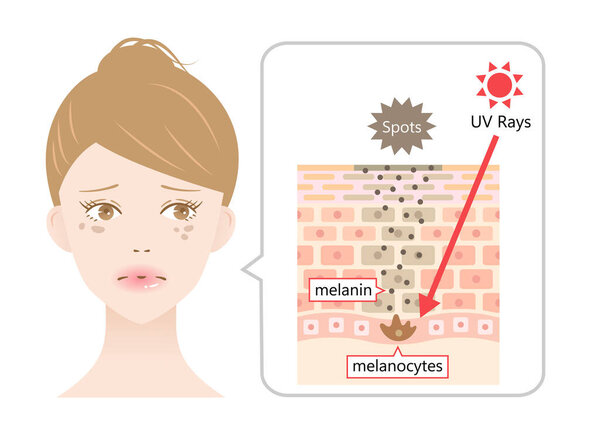 suns UV radiation induces dark spot on young womans face by melanin. Human skin layer and cell illustration. Beauty and health care concept 