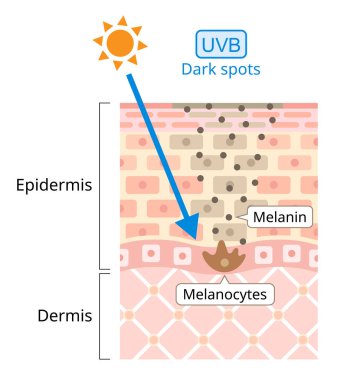 UVB insan derisine zarar verir. Ultraviyole B (UVB) daha kısa bir dalga boyuna sahiptir. Karanlık Nokta ile ilişkilendirilir. Güzellik ve sağlık hizmeti konsepti