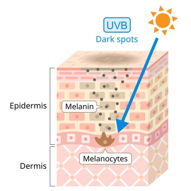 UVB insan derisine zarar verir. Ultraviyole B (UVB) daha kısa bir dalga boyuna sahiptir. Karanlık Nokta ile ilişkilendirilir. Güzellik ve sağlık hizmeti konsepti