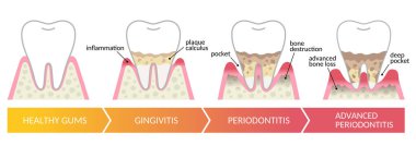 Periodontal hastalığın aşamaları. diş ve ağız sağlığı konsepti