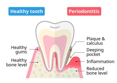 Sağlıklı diş ve periodontal hastalık. Diş ve ağız sağlığı konsepti.