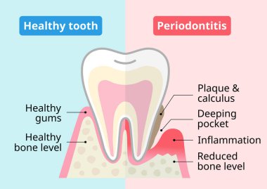 Sağlıklı diş ve periodontal hastalık. Diş ve ağız sağlığı konsepti.