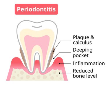 periodontit diş ve diş etleri periodontal cep ve kemik tahribatı. Diş ve ağız sağlığı konsepti.