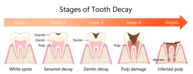 Stages of Tooth Decay illustration. Dental and oral health care concept. clipart