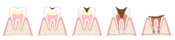 Fasi Della Carie Illustrazione Concetto Assistenza Dentale Orale — Vettoriale Stock