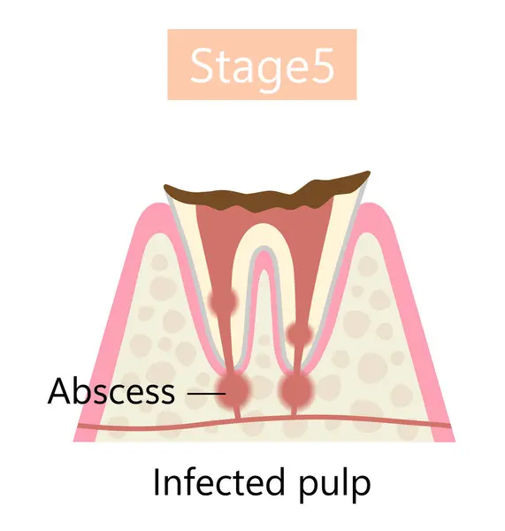 Laatste Fase Van Tandbederf Abces Vorming Tandheelkundige Orale Gezondheidszorg — Stockvector