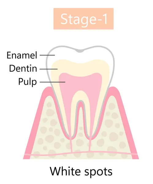 Prvním Stádiem Rozpadu Zubů Počáteční Demineralizace Koncepce Dentální Ústní Zdravotní — Stockový vektor