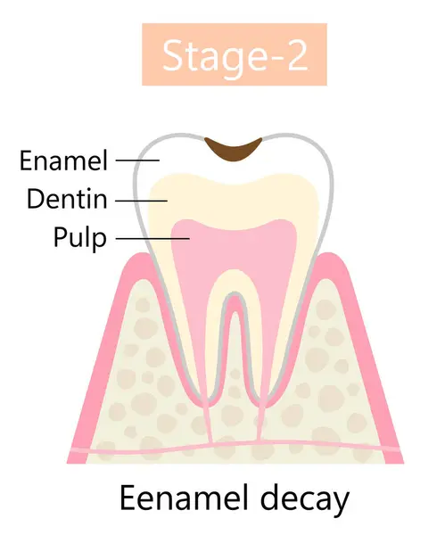 Síntoma Caries Dental Caries Del Esmalte Resulta Formación Cavidades Dentales — Archivo Imágenes Vectoriales