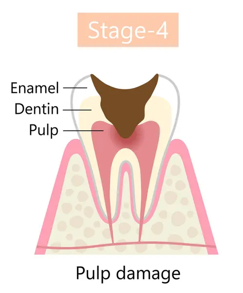 Tooth Decay Symptom Pulp Damage Dental Oral Health Care Concept — Stock Vector