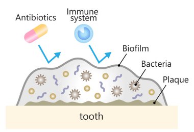Diş illüstrasyonunda diş biyofilmi. diş ve ağız bakımı kavramı