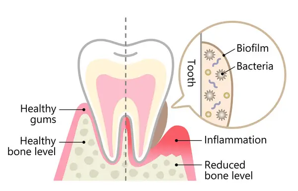 Biofilm Dentale Dente Sano Igiene Dentale Concetto Assistenza Sanitaria — Vettoriale Stock