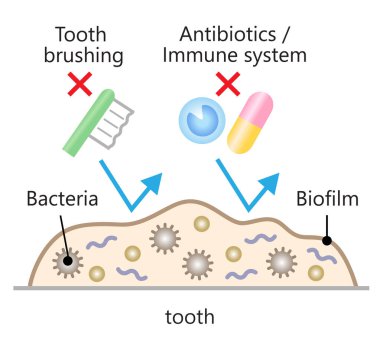 Antibiyotikler ve diş fırçalama bulaşıcı diş biyofilmlerini çıkaramaz. Diş sağlığı ve ağız sağlığı konsepti
