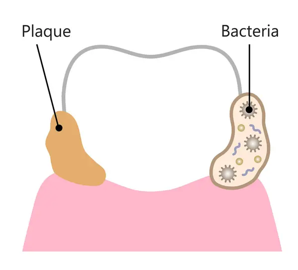 Bacteria Plaque Attachment Tooth Initial Dental Biofilm Illustration Dental Health — Stock Vector