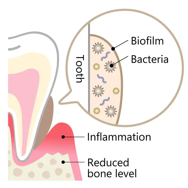 Biofilm Dentale Sull Illustrazione Dei Denti Igiene Dentale Cura Orale — Vettoriale Stock
