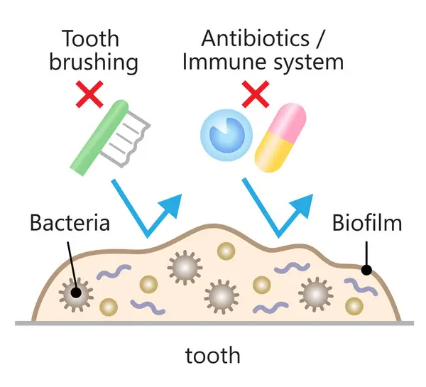Los Antibióticos Cepillado Dental Pueden Eliminar Las Biopelículas Dentales Infecciosas — Archivo Imágenes Vectoriales
