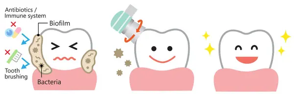 Tandheelkundige Biofilm Verwijdering Schattig Karakter Illustratie Tandheelkundige Gezondheidszorg Mondverzorging — Stockvector