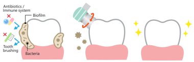 Diş biyofilmi temizleme illüstrasyonu. Dişte bakteri ve plaket var. Diş sağlığı ve ağız sağlığı konsepti