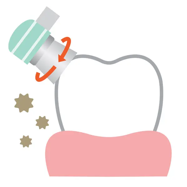Illustrazione Rimozione Biofilm Dentale Batterio Placca Attaccata Dente Salute Dentale — Vettoriale Stock