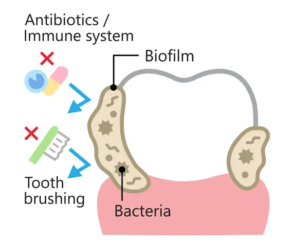 Tandheelkundige Biofilm Verwijdering Illustratie Bacteriën Plaque Bevestiging Tand Tandheelkundige Gezondheidszorg — Stockvector