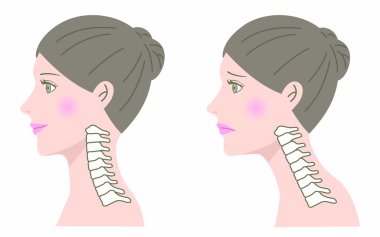 Düz boyun sendromu ve sağlıklı boyun. Sağlık hizmeti kavramı