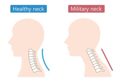düz boyun sendromu ve sağlıklı boyun nötr insan kafası. Sağlık hizmeti kavramı