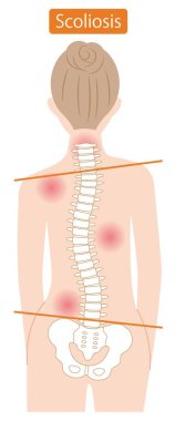 Biçimsiz kadın omurgası. Omurgalı sütun. Beyaz arkaplanda izole.