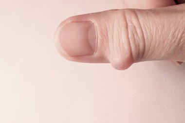 Ganglion cyst, synovial cyst disease, on the thumb of a womans hand. Selective focus. clipart