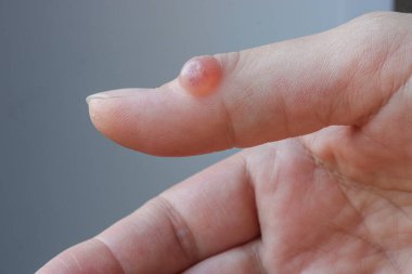 Baş parmağında higroma olan bir kadın eli. Seçici odak.