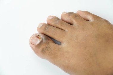 Close-Up of Foot with Skin Condition and a toe injury clipart