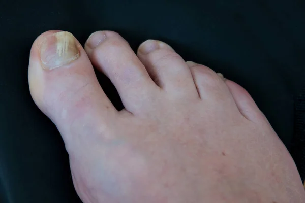 Close up of a toe with nail fungus, causing thickened nail and discolor.
