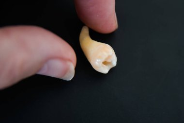 Human hand close to a extracted cheektooth. Black background