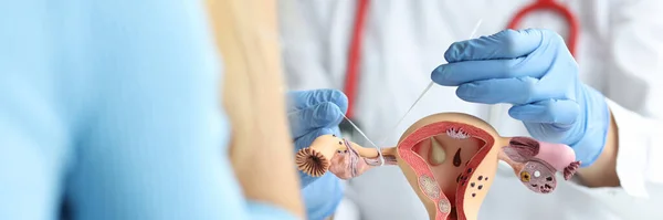 Close Doctor Gynecologist Ligates Fallopian Tubes Female Reproductive System Example — Stock Photo, Image