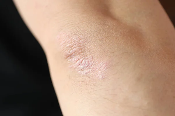 Psoriatiska Plack Armbågen Hos Patienter Med Hudsjukdom Närbild Diagnos Och — Stockfoto