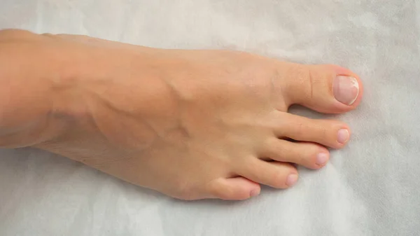 Sağlıksız Tırnağıyla Ayak Ayak Parmaklarının Üst Görüntüsü Tırnak Sorunları Enfeksiyonlar — Stok fotoğraf