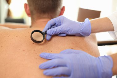 Erkek hastanın sırtındaki pigmentasyonu inceleyen büyüteçle doktorun yakın çekimi. Cerrah erkek vücudundaki benlere bakıyor. Estetik kozmetoloji kavramı