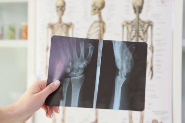 Doktor muayenehanesindeki iskeletlere karşı bilek röntgeni çeken bir kadın eli. Hastanedeki kemiklerin ve eklemlerin profesyonel kontrolü.