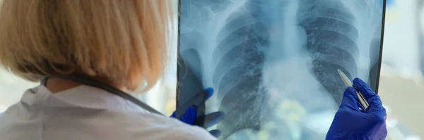 Doktor Vyšetřuje Rentgen Hrudníku Pacienta Nemocnici Pneumonie Nebo Bronchitida Lékařské — Stock fotografie