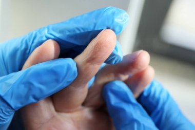 Lastik eldivenli doktor hasta parmaklarını egzama ile dikkatlice muayene eder. Dermatolog, bulanık arka plan üzerine modern klinikte randevu veriyor.